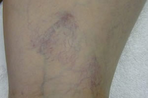 vein removal legs before larchmont